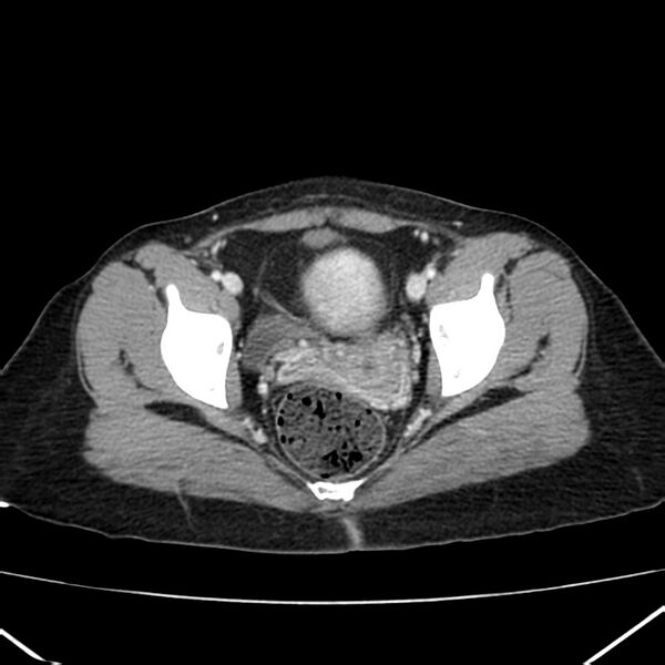 File:Ampullary tumor (Radiopaedia 22787-22816 C 63).jpg