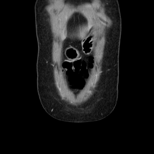 File:Ampullary tumor (Radiopaedia 22787-22816 E 8).jpg