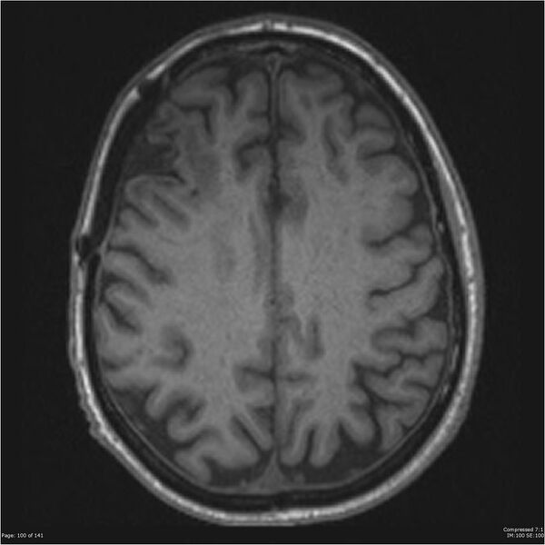File:Anaplastic meningioma with recurrence (Radiopaedia 34452-35788 Axial T1 98).jpg