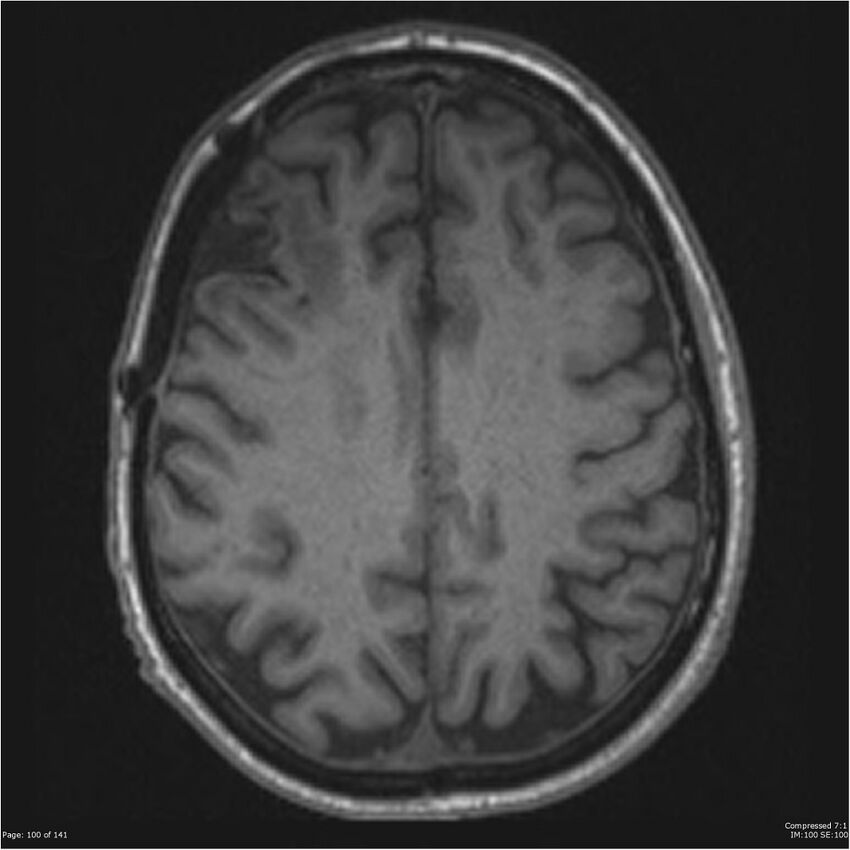 Anaplastic meningioma with recurrence (Radiopaedia 34452-35788 Axial T1 98).jpg