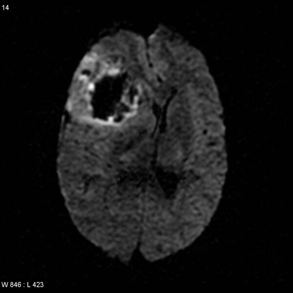 File:Anaplastic oligodendroglioma NOS (hemorrhagic) (Radiopaedia 5418-7169 Axial DWI 1).jpg