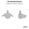 Anderson and D'Alonzo classification of C2 odontoid fractures (diagrams) (Radiopaedia 87249-103528 type 2a 1).jpeg