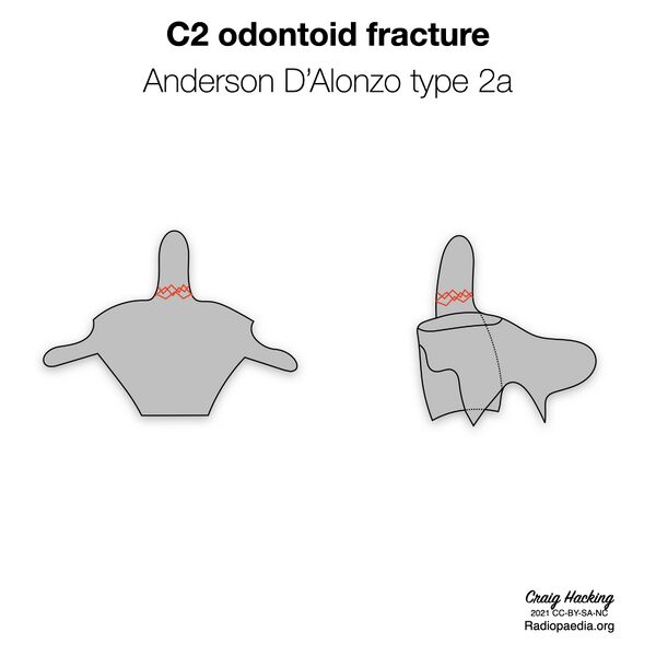 File:Anderson and D'Alonzo classification of C2 odontoid fractures (diagrams) (Radiopaedia 87249-103528 type 2a 1).jpeg