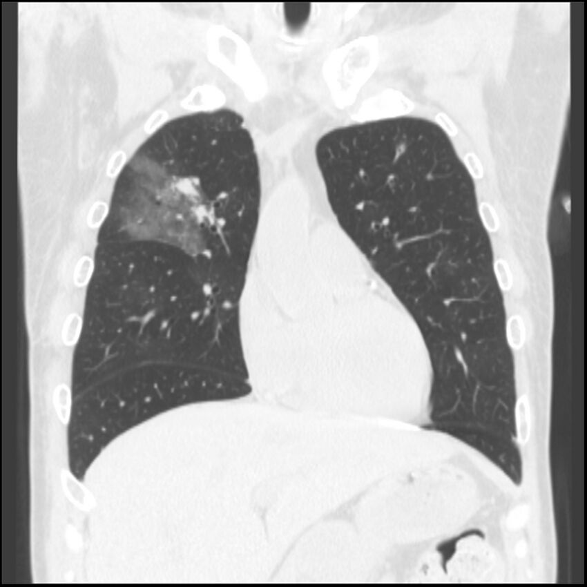 Angioinvasive aspergillosis (Radiopaedia 43957-47466 Coronal lung window 64).jpg