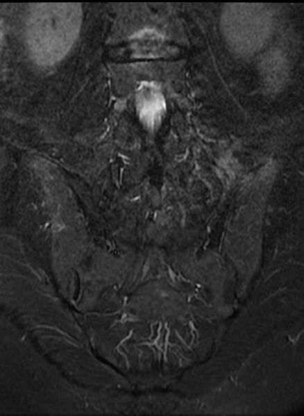 File:Ankylosing spondylitis - Andersson lesion (Radiopaedia 81878-95838 Coronal STIR 10).jpg
