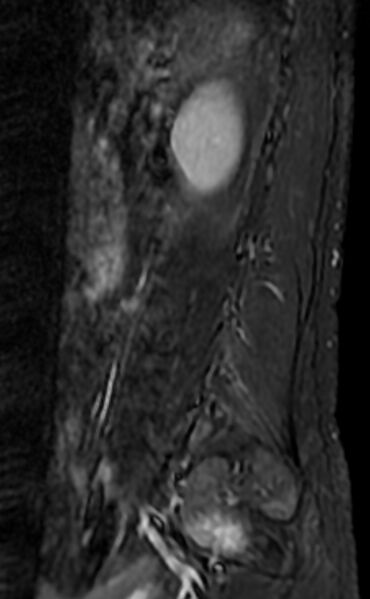 File:Ankylosing spondylitis - Andersson lesion (Radiopaedia 81878-95838 Sagittal STIR 1).jpg