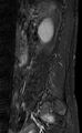 Ankylosing spondylitis - Andersson lesion (Radiopaedia 81878-95838 Sagittal STIR 1).jpg
