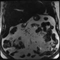 Annular pancreas (Radiopaedia 38292-40320 Coronal T2 23).png