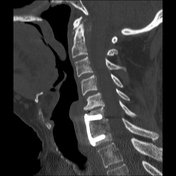 File:Anterior cervical postdiscectomy arthrodesis (Radiopaedia 32678-33646 Sagittal bone window 39).jpg