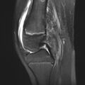 Anterior cruciate ligament tear - pediatric (Radiopaedia 62152-70260 Sagittal PD fat sat 17).jpg