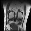 Anterior cruciate ligament tear with posteromedial corner injury, bucket-handle meniscal tear and chondral delamination (Radiopaedia 75501-86744 Coronal T1 19).jpg