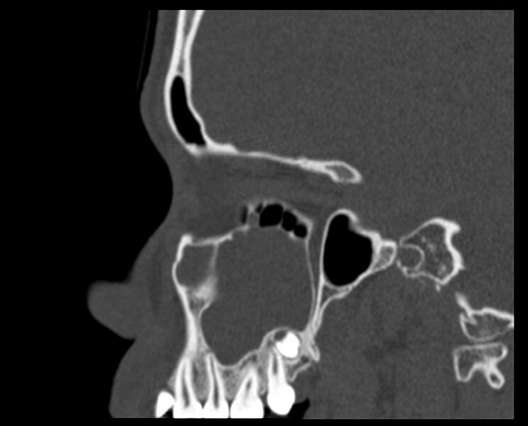 File:Antrochoanal polyp (Radiopaedia 21894-21868 Sagittal bone window 12).jpg