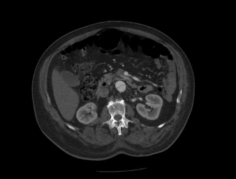 File:Aortic dissection (Radiopaedia 28802-29105 A 57).jpg