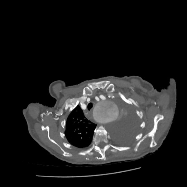 File:Aortic dissection (Radiopaedia 68763-78691 A 3).jpeg