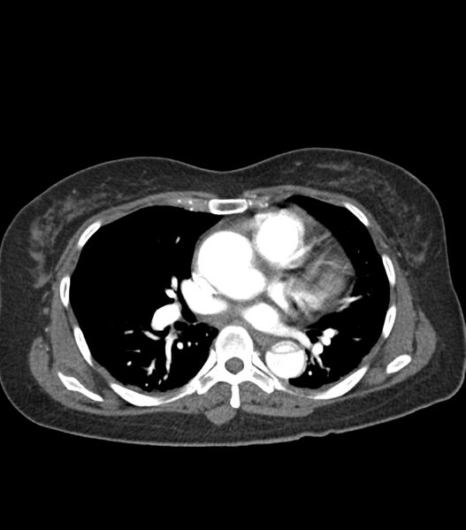File:Aortic dissection with renal ischemia (Radiopaedia 76573-88338 A 34).jpg