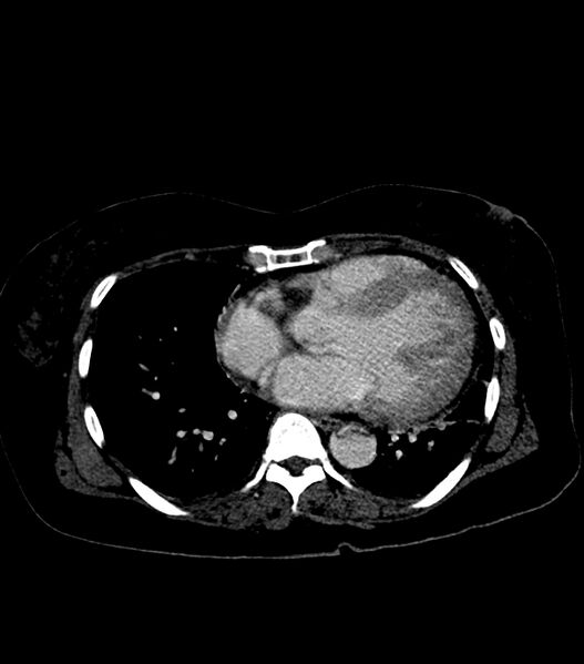 File:Aortic dissection with renal ischemia (Radiopaedia 76573-88338 B 17).jpg