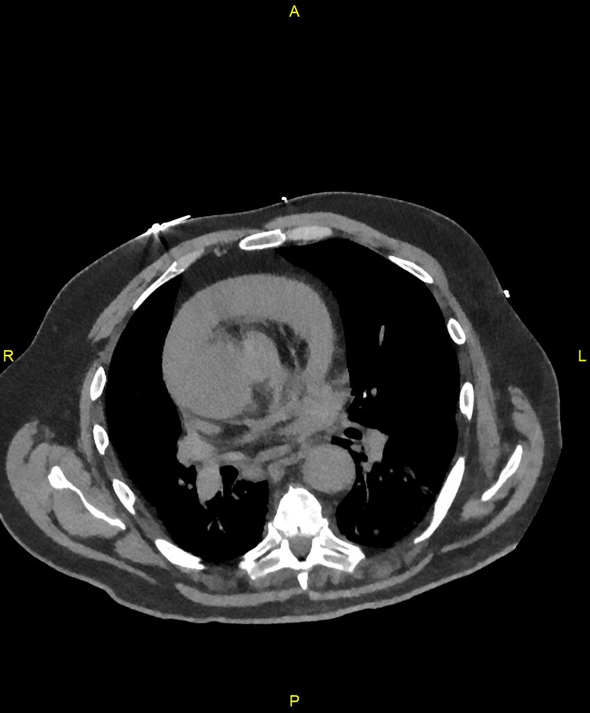 Aortic rupture (Radiopaedia 88822-105594 Axial non-contrast 110).jpg