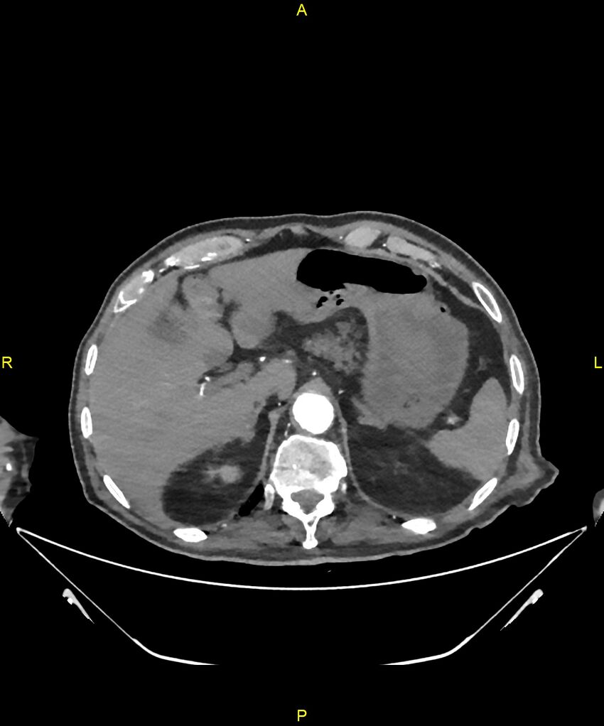 Aortoenteric fistula (Radiopaedia 84308-99603 B 63).jpg