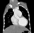 Aortopulmonary window, interrupted aortic arch and large PDA giving the descending aorta (Radiopaedia 35573-37074 D 21).jpg