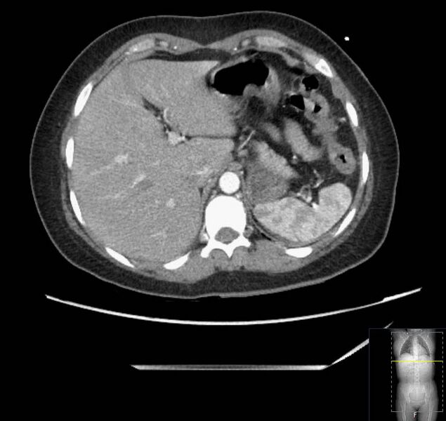 File:Appendicitis (CT angiogram) (Radiopaedia 154713-127660 Axial 158).jpg
