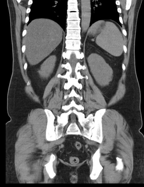 File:Appendicitis and giant appendicolith (Radiopaedia 80251-93588 Coronal non-contrast 35).jpg