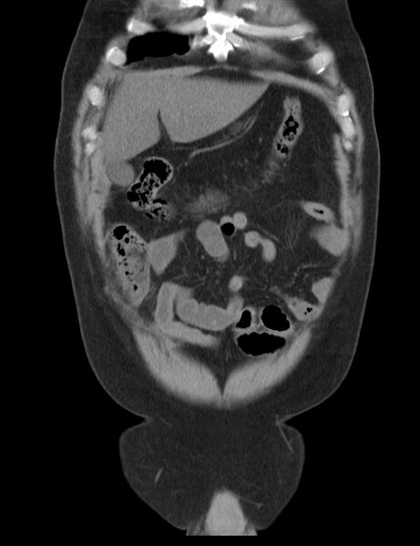 File:Appendicitis and giant appendicolith (Radiopaedia 80251-93588 Coronal non-contrast 8).jpg
