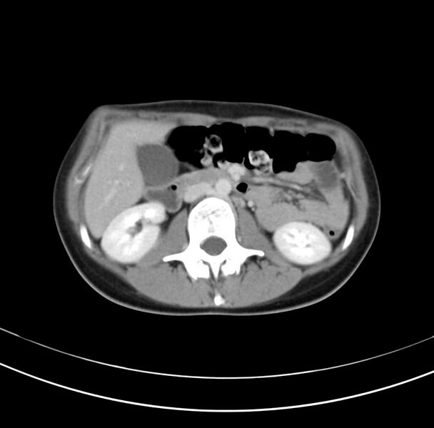 File:Appendicitis and incidental bicornuate uterus (Radiopaedia 22833-22853 B 18).jpg