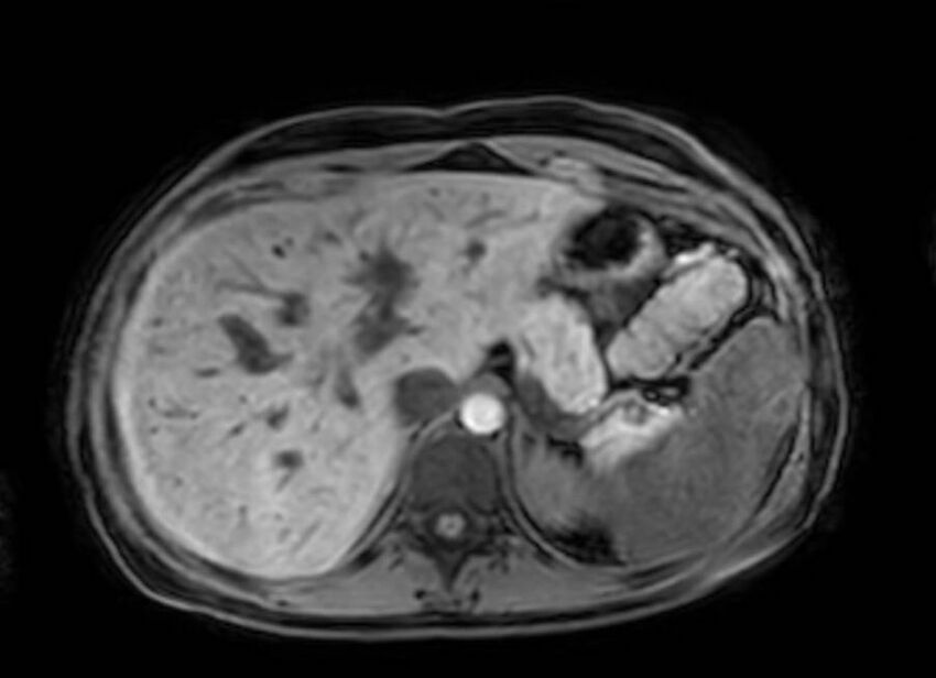 Appendicitis in gravida (MRI) (Radiopaedia 89433-106395 Axial DIXON 23).jpg