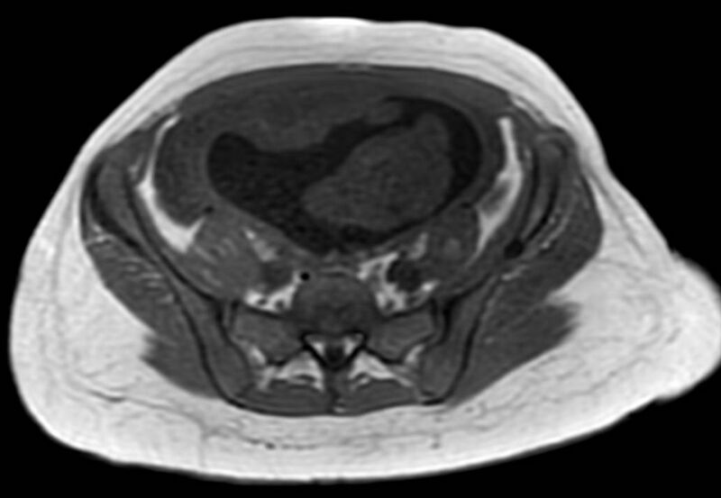 File:Appendicitis in gravida (MRI) (Radiopaedia 89433-106395 Axial T1 in-phase 50).jpg