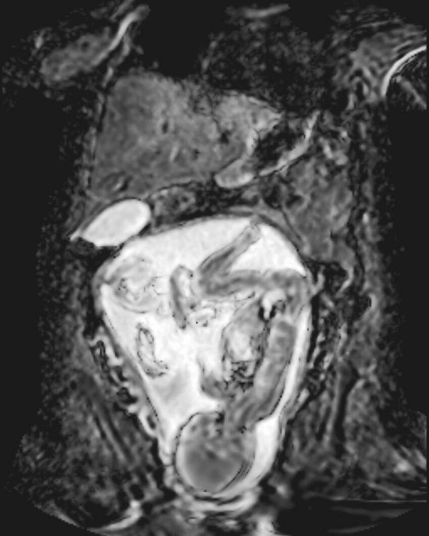 Appendicitis in gravida (MRI) (Radiopaedia 89433-106395 Coronal ADC 22).jpg