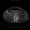 Arachnoiditis ossificans (Radiopaedia 51394-57136 Axial bone window 21).jpg