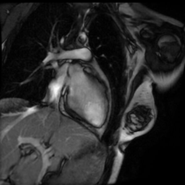 File:Arrhythmogenic right ventricular cardiomyopathy (Radiopaedia 87505-103850 2ch (LV) Cine SSFP 20).jpg