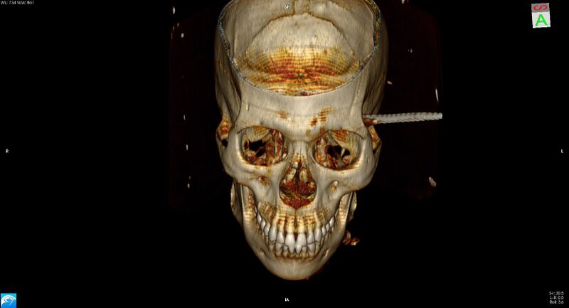 File:Arrow injury to the head (Radiopaedia 75266-86388 3D vertical 8).jpg