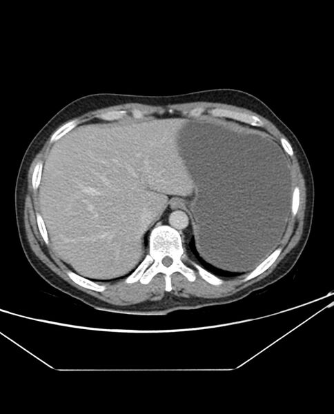 File:Arterial occlusive mesenteric ischemia (Radiopaedia 84641-100054 A 19).jpg