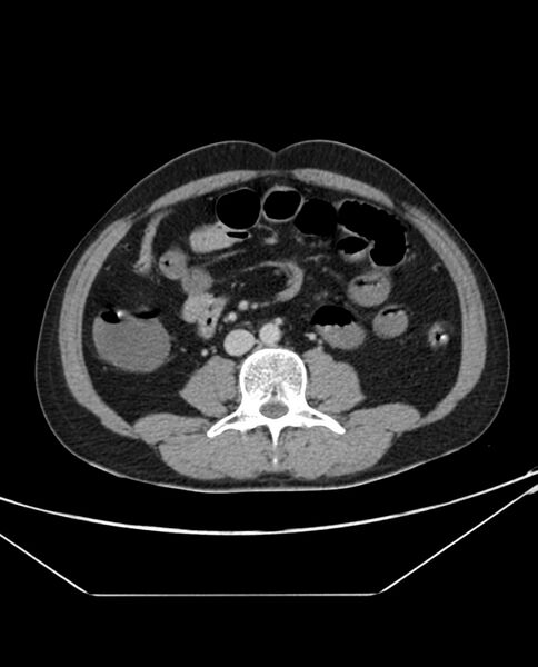 File:Arterial occlusive mesenteric ischemia (Radiopaedia 84641-100054 A 64).jpg