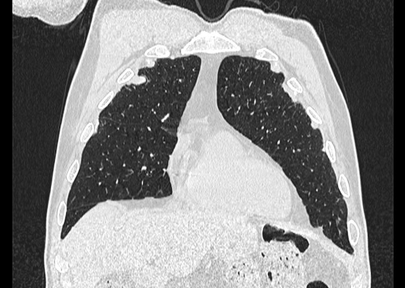 File:Asbestos pleural placques (Radiopaedia 57905-64872 Coronal lung window 61).jpg