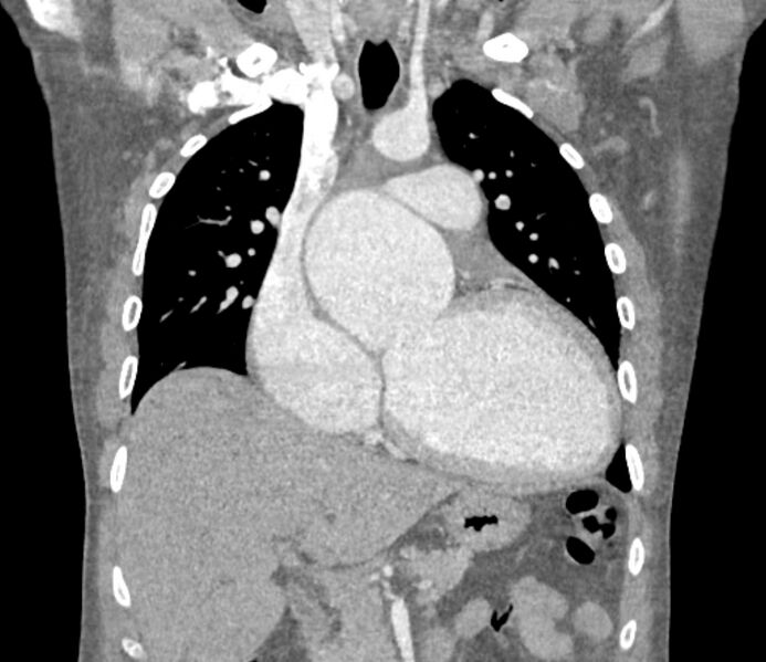 File:Ascending aortic aneurysm (Radiopaedia 86279-102297 B 26).jpg