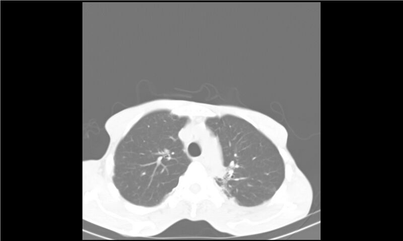 File:Aspergilloma (Radiopaedia 20788-20701 Axial lung window 10).jpg