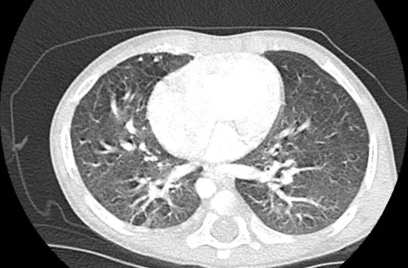 File:Asplenia syndrome (Radiopaedia 73083-83792 Axial lung window 43).jpg