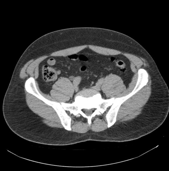 File:Atrophic kidney due to severe chronic obstructive hydronephrosis (Radiopaedia 40828-43474 Axial non-contrast 29).jpg