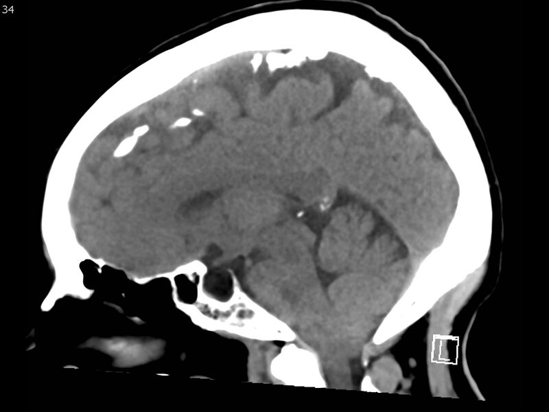 File:Atypical meningioma - intraosseous (Radiopaedia 64915-73867 C 32).jpg