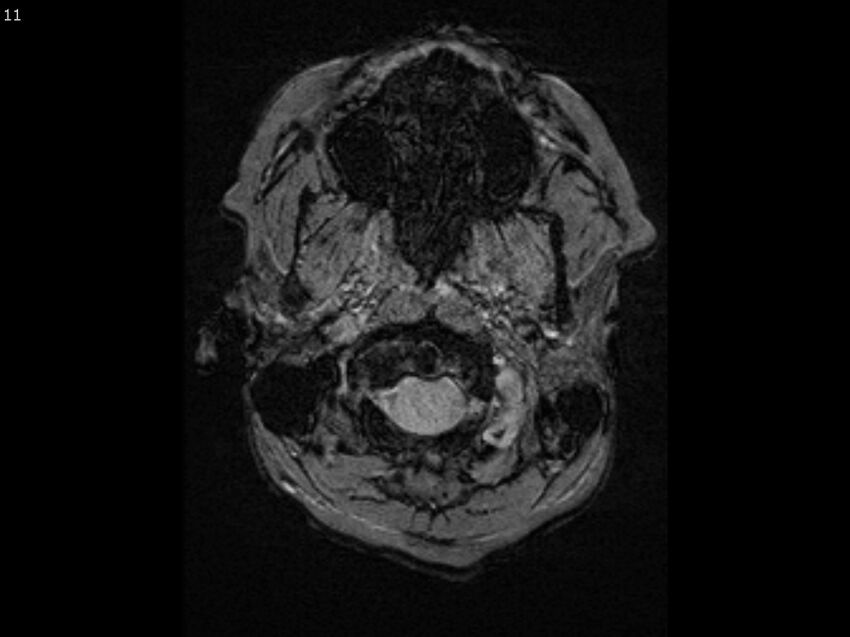 Atypical meningioma - intraosseous (Radiopaedia 64915-74572 Axial SWI 11).jpg