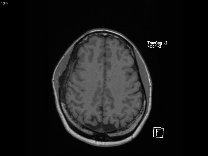 Atypical meningioma - intraosseous (Radiopaedia 64915-74572 Axial T1 139).jpg
