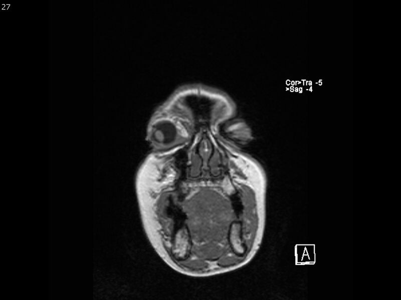 File:Atypical meningioma - intraosseous (Radiopaedia 64915-74572 Coronal T1 27).jpg