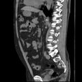 Autosomal dominant polycystic kidney disease (Radiopaedia 36539-38101 D 49).jpg