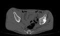 Avascular necrosis of the left hip (Radiopaedia 75068-86125 Axial bone window 10).jpg