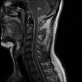 Axis fracture - MRI (Radiopaedia 71925-82375 Sagittal T2 4).jpg
