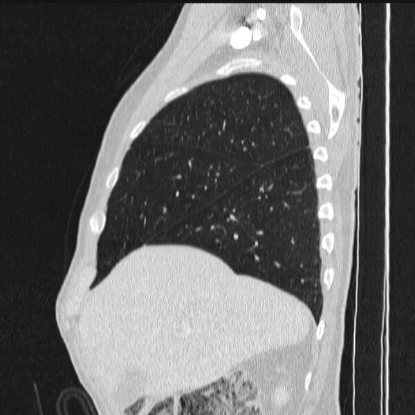 File:Azygos lobe (Radiopaedia 38259-40275 lung window 22).jpg