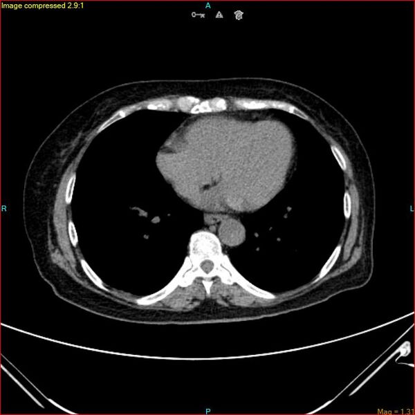 File:Azygos vein aneurysm (Radiopaedia 77824-90130 A 40).jpg