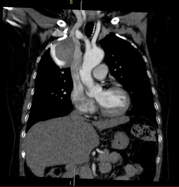 File:Azygos vein aneurysm (Radiopaedia 77824-90130 C 13).JPG
